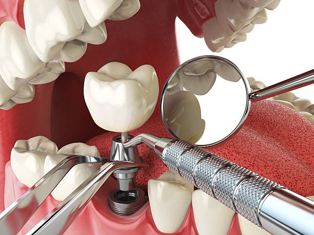 Best Emergency Broken Tooth Repair in Joppatowne, MD